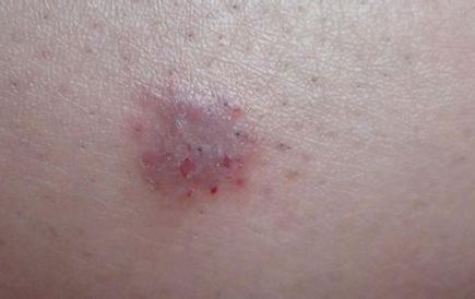 皮膚癌癥狀圖片