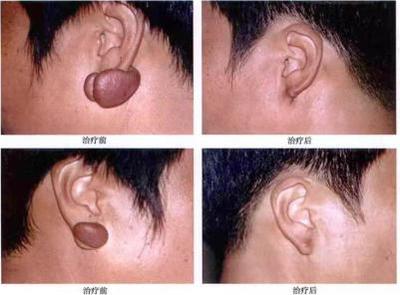 跟瘢痕疙瘩、皮膚血管瘤說拜拜--放射性核素敷貼治療