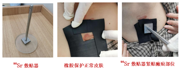 瘢痕疙瘩又丑、又癢、又痛怎么辦?它的&ldquo;克星&rdquo;來了